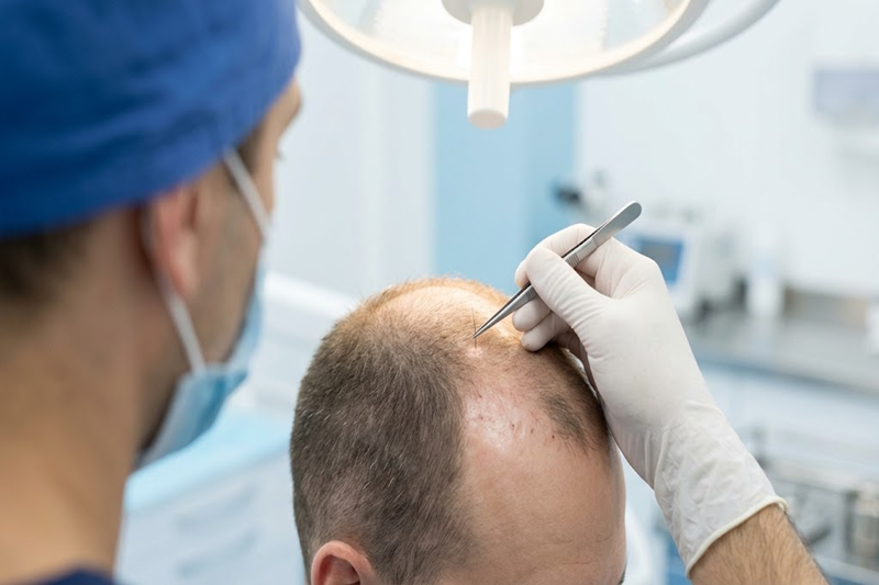 Hair transplant surgeon implanting hair grafts into a thinning scalp
