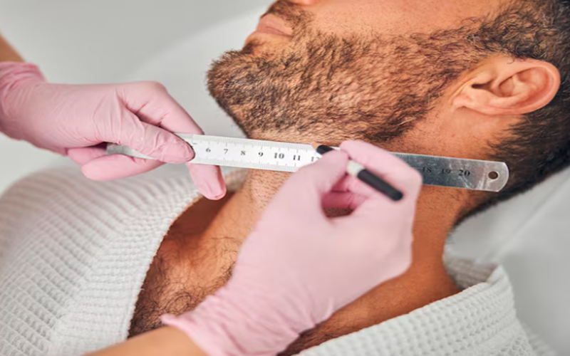 Beard Transplant: Guide to a Fuller Facial Hair