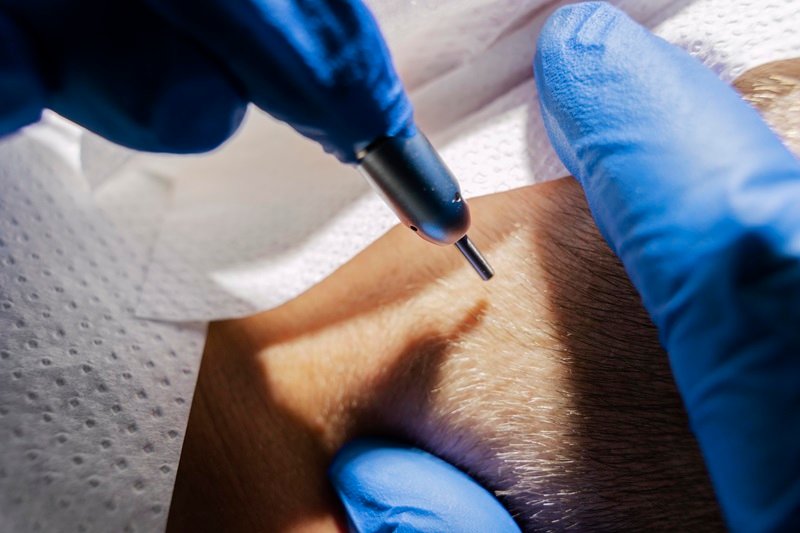 FUE Hair Transplant Graft Extraction Procedure