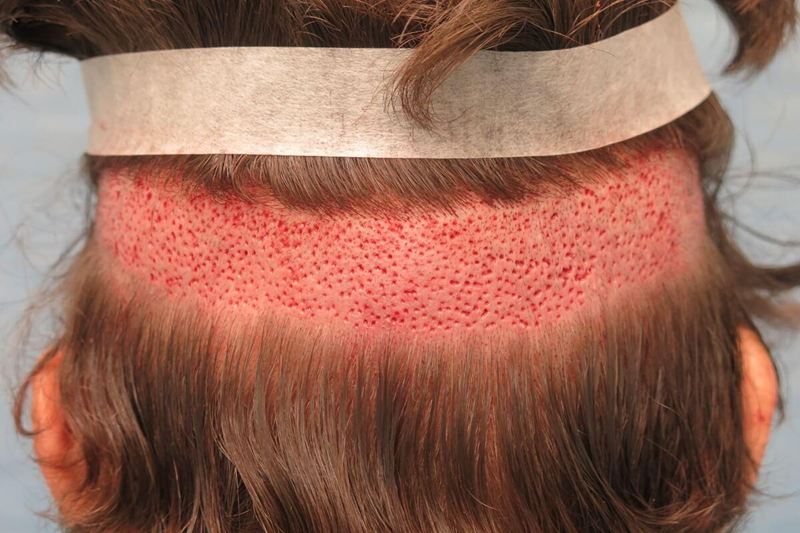 Hair Transplant Donor Area on the Back of the Scalp