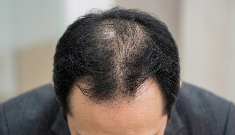 Neo Follicle Hair Transplant: How It Works & Results