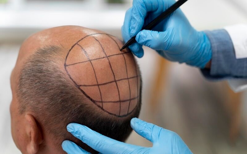 Best Hair Transplant Method: Pros & Cons of Popular Techniques