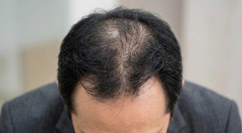 Neo Follicle Hair Transplant: How It Works & Results