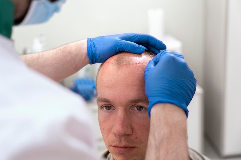 Micrograft Hair Transplant