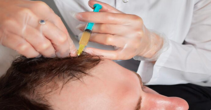 Body Hair Transplant (BHT): Unlock More Donor Options