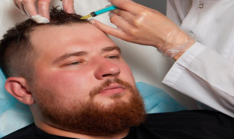 NeoGraft Hair Transplant: A Realistic Look