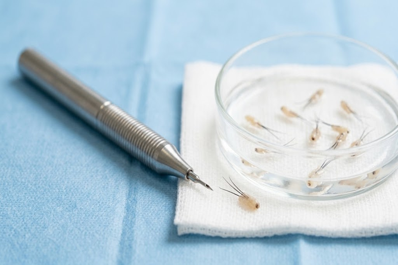Hair Graft Preparation and Implantation for Hair Transplantation