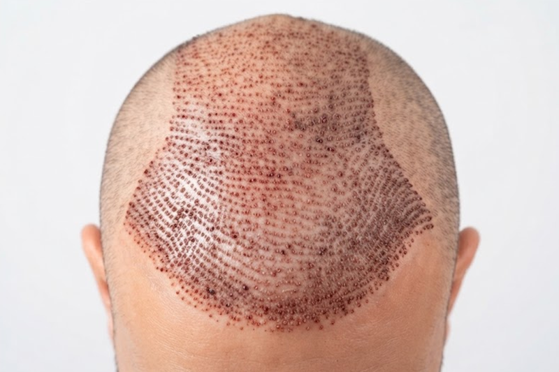 FUE Hair Transplant