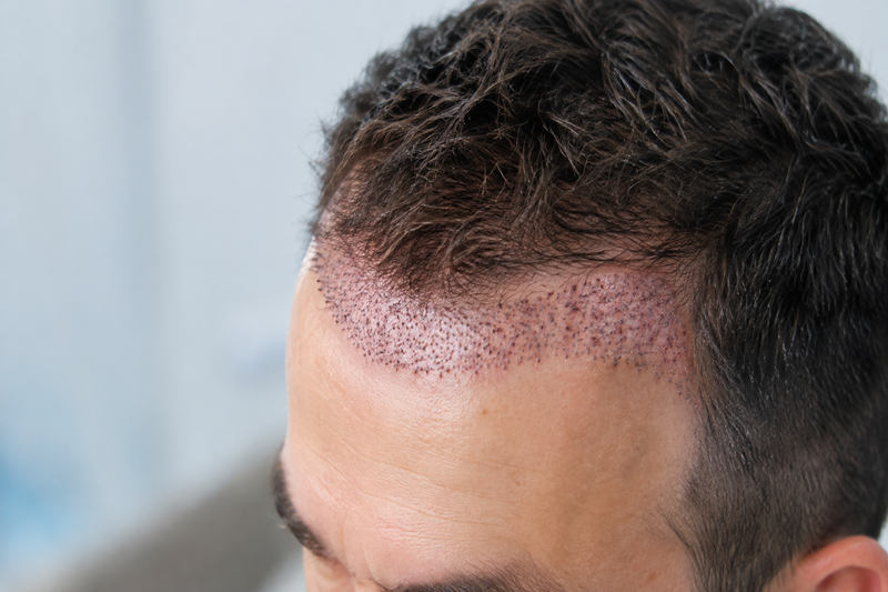Hair transplant recovery and possible limitations
