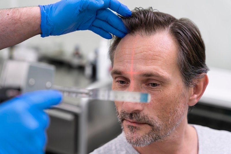 Factors affecting hair transplant results