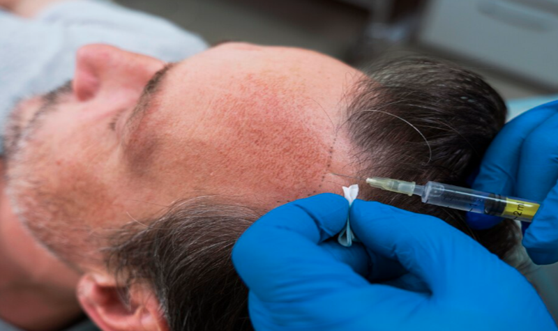 Stem Cell Hair Transplants: The Future of Natural Hair Restoration
