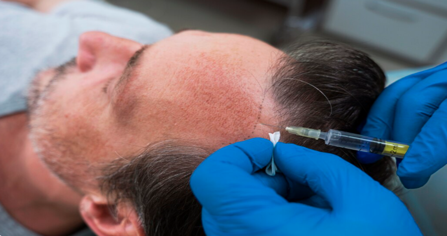 Stem Cell Hair Transplants: The Future of Natural Hair Restoration