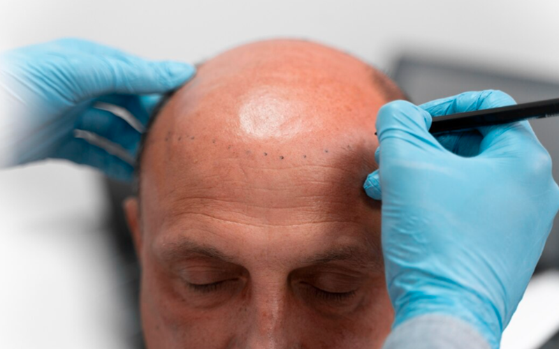 Vertex Hair Transplant: The Art of Restoring the Crown