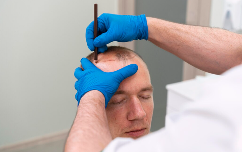 FUT Hair Transplants: Cost, Benefits, and Recovery
