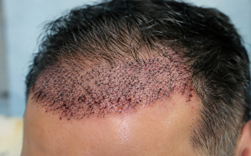 Hair Transplant Infection: Signs, Causes & What to Do