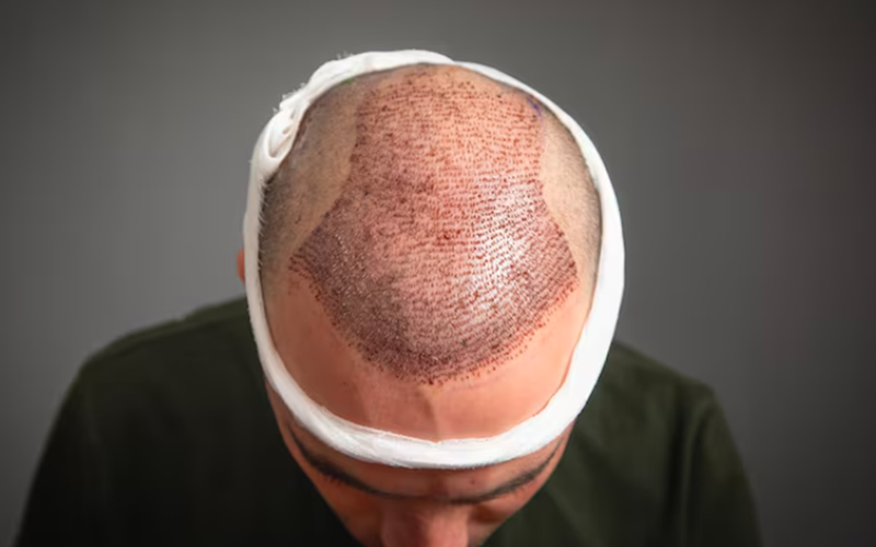 Hair Transplants on Scars: Get the Facts Here