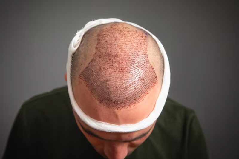Hair Transplants on Scars: Get the Facts Here