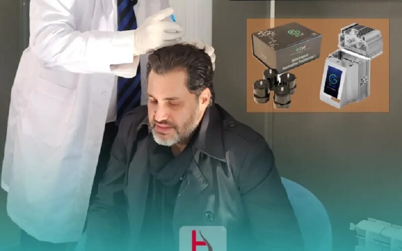 G Cell Hair Transplantation: Combat Hair Loss with Cell Therapy