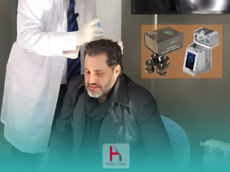G Cell Hair Transplantation: Combat Hair Loss with Cell Therapy