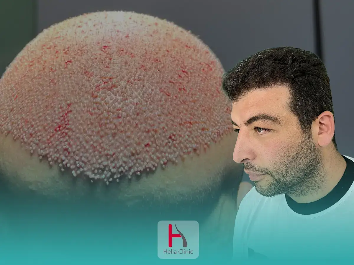 High Density Hair Transplant: Techniques For Full Coverage & Cost