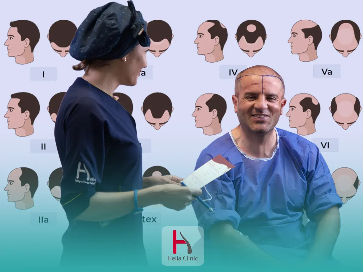 Male Pattern Hair Loss: Stages, Causes, and Treatments