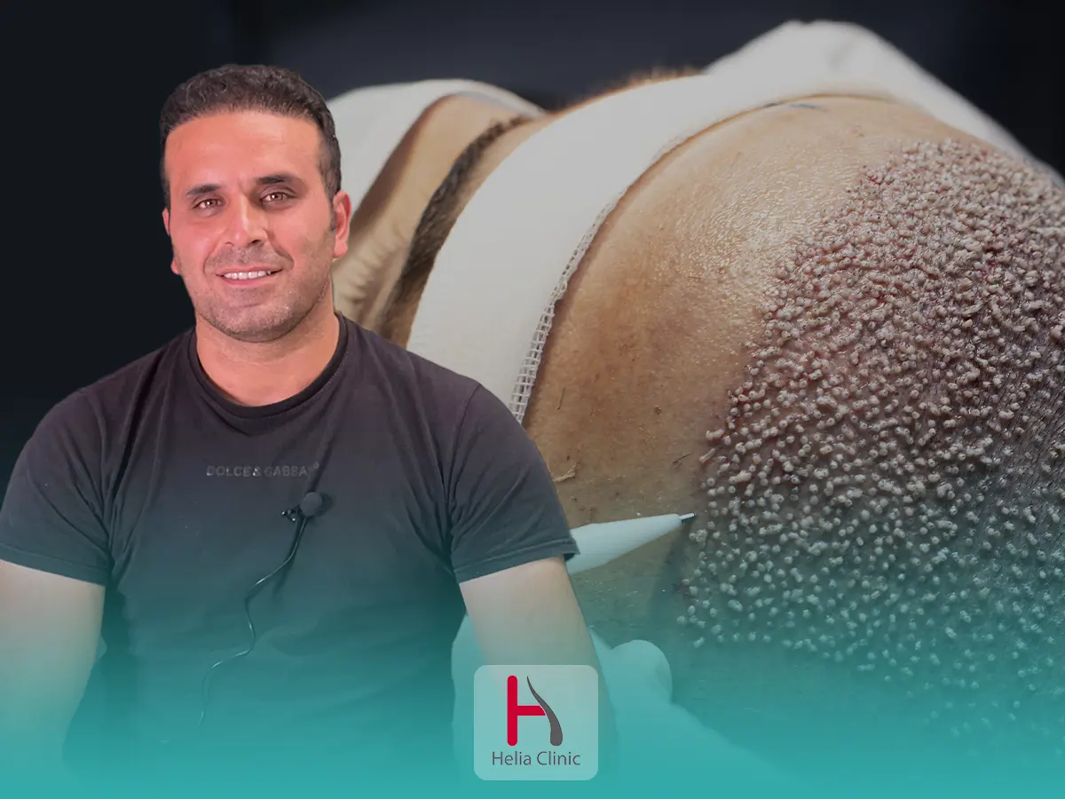Hair Transplant Success Rate: How to Overcome the Causes of Failure