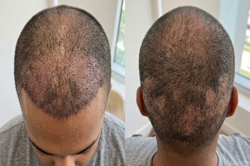 Recipient and donor area shock loss after hair transplant