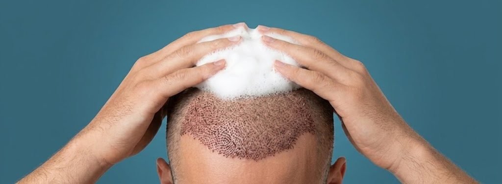 Water temperature and pressure are two of the easiest things to control when washing hair after hair transplant.