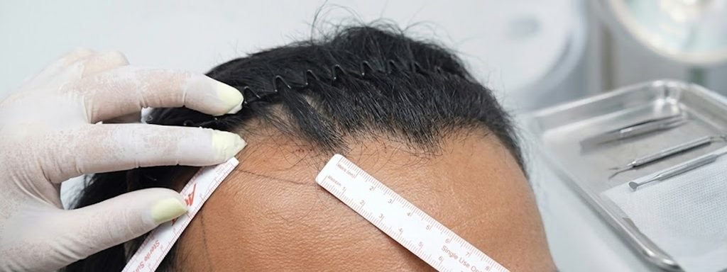 Donor depleted restoration refers to hair restoration planning for patients who have limited donor hair remaining.