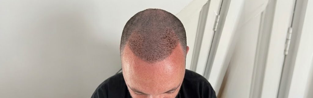 Small scabs or crusts around transplanted grafts are a normal part of the healing process