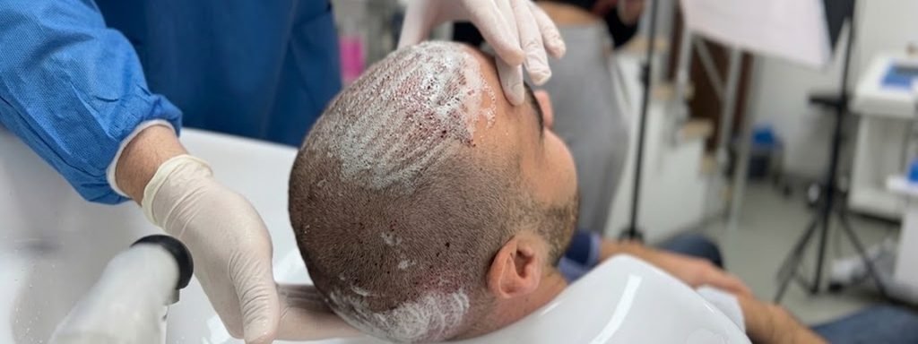 During the first week, crusts may form around transplanted follicles