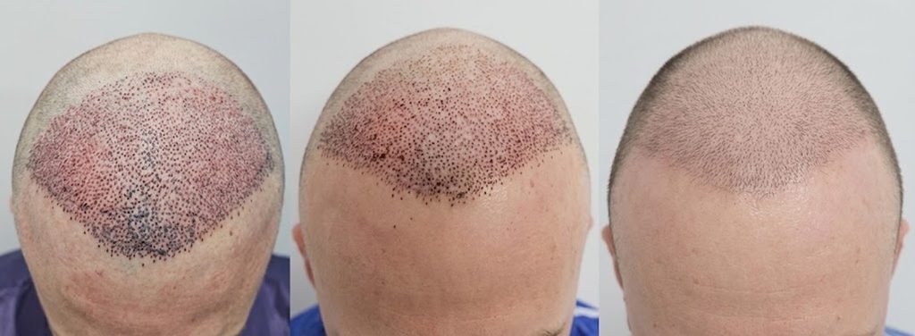 Mistakes When Washing Hair After a Hair Transplant