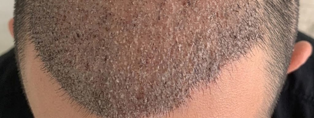 scalp can still be sensitive after 14 days