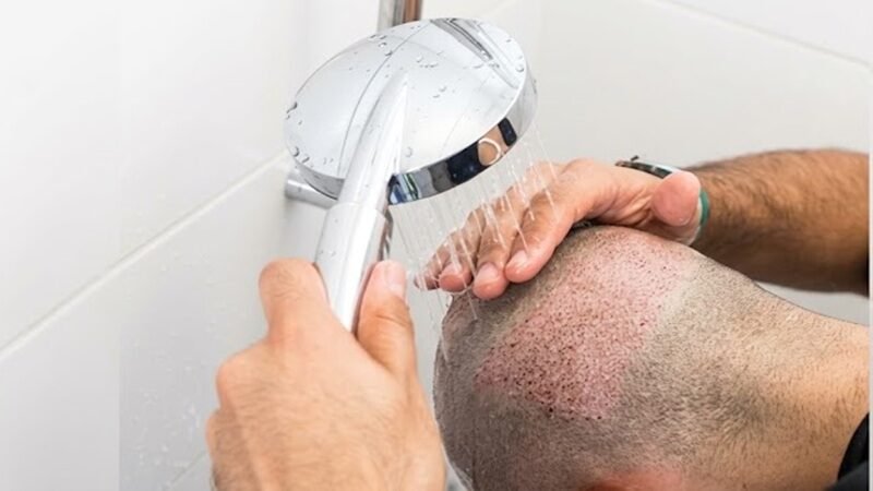 How To Wash Hair After a Hair Transplant: 6 Expert Tips