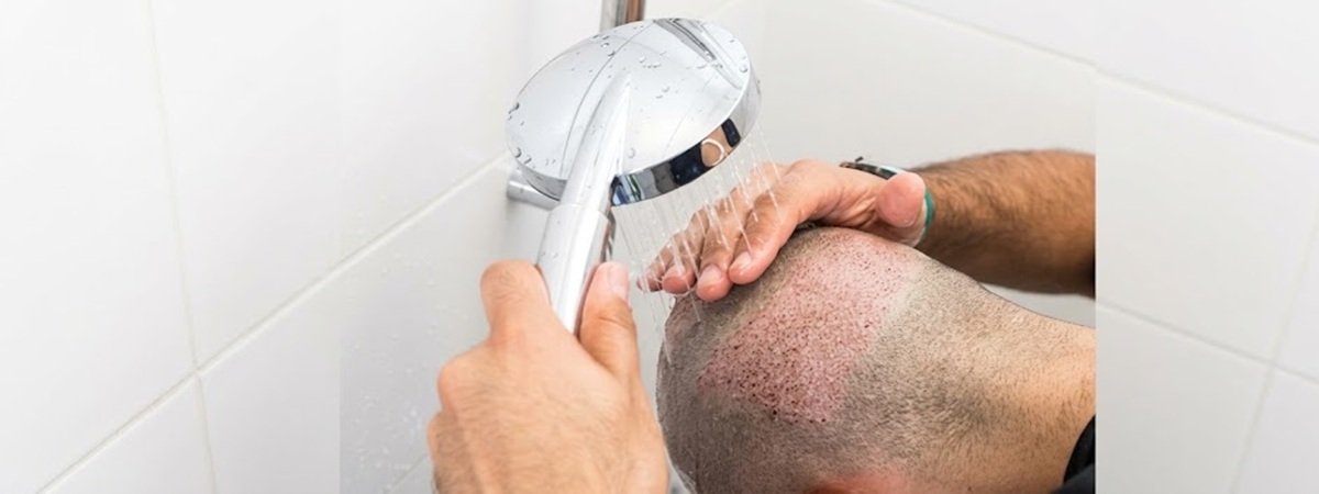 How To Wash Hair After a Hair Transplant: 6 Expert Tips