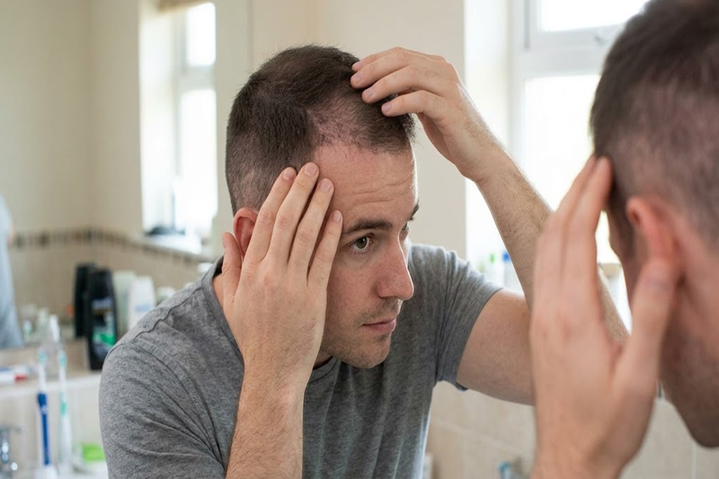 Normal amount of shock loss after hair transplant