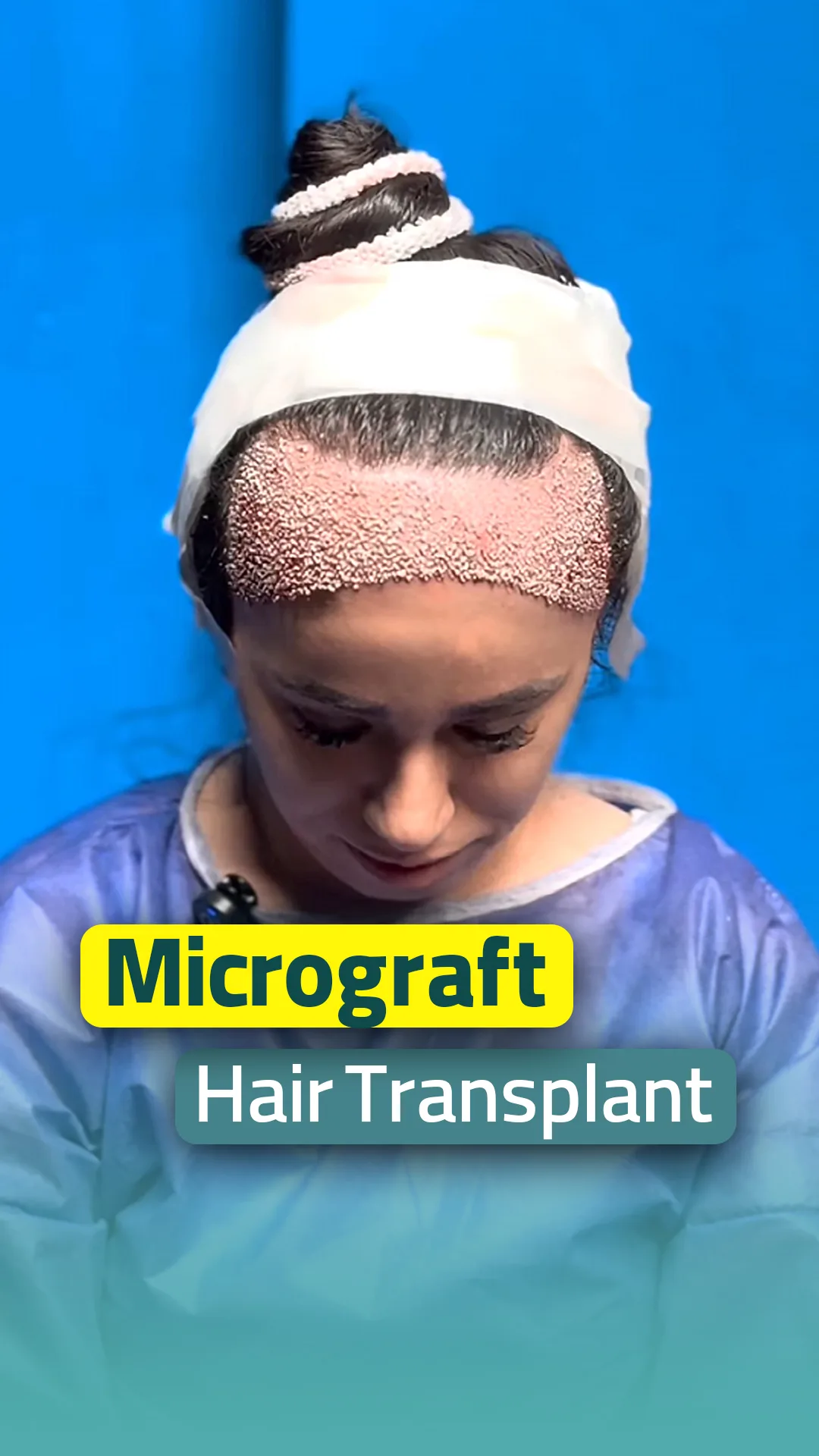 After female hair transplant Micrograft at Helia Clinic Dubai — newly implanted follicles on the forehead.