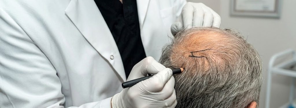 Both robotic and manual approaches can be used for follicular unit extraction (FUE)