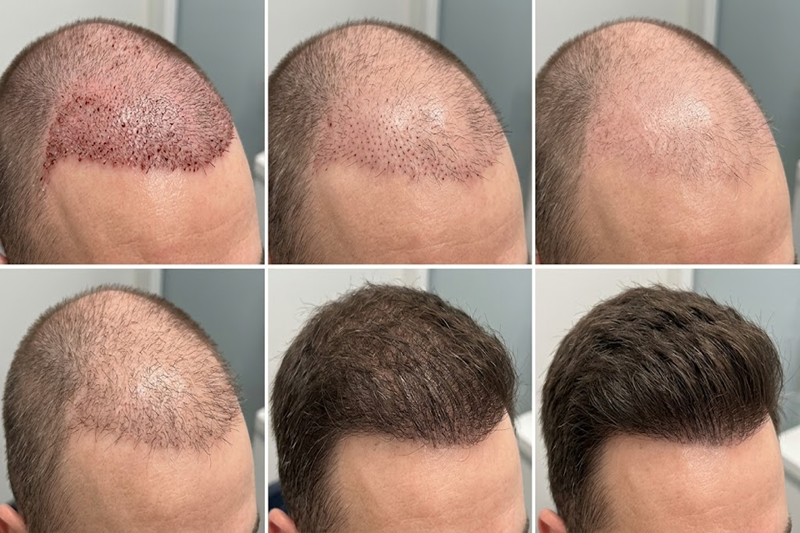 Hair Transplant Shock Loss Timeline