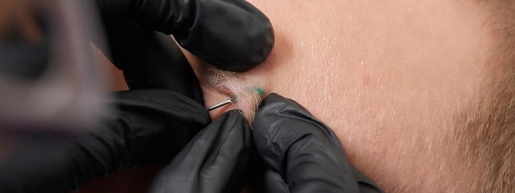 A body hair transplant (BHT) is a hair restoration procedure that uses follicles from non-scalp donor areas