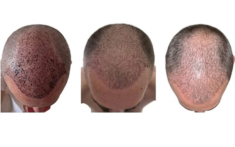 Hair Transplant Recovery Day by Day: The First 14 Days