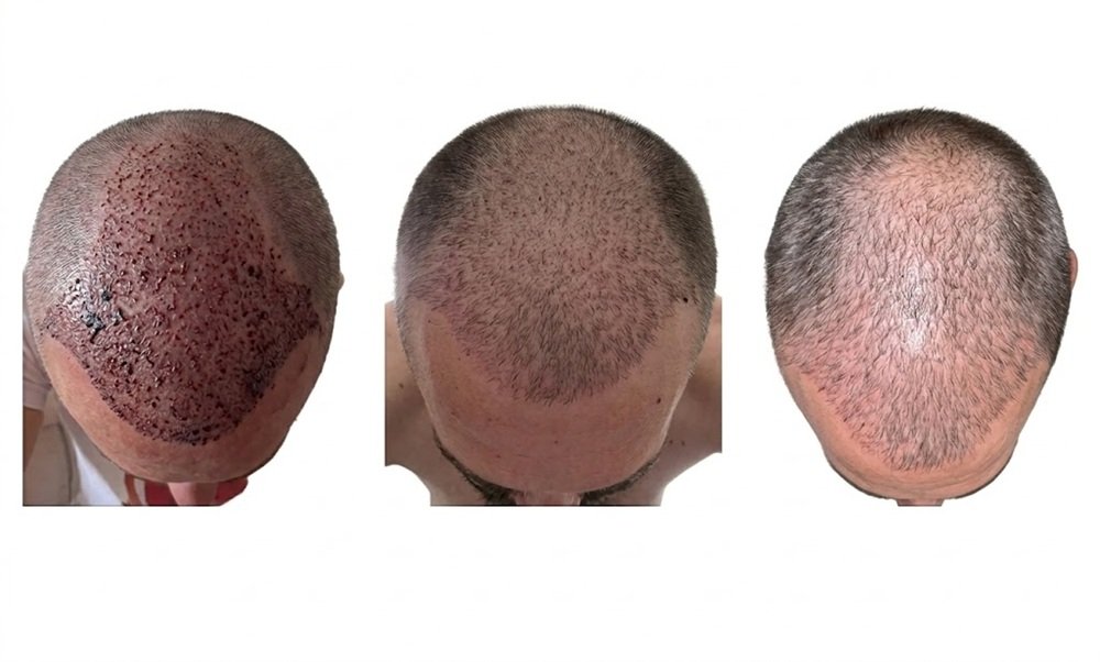 Hair Transplant Recovery Day by Day: The First 14 Days