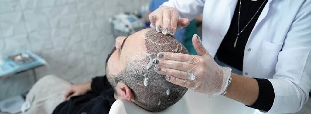 Wash hair after a hair transplant only when your surgeon or hair transplant provider has cleared you to do so.