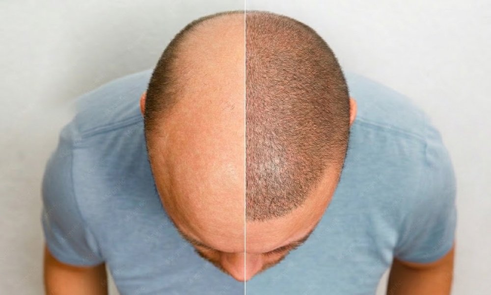 The appropriate technique can also depend on the pattern and extent of hair loss