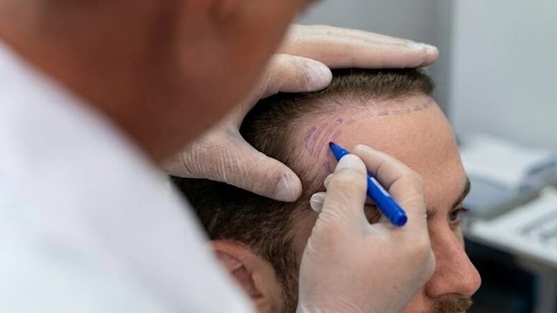 FUE vs FUT Hair Transplant: Which One Gives Better Results?