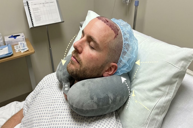 what to avoid while sleeping after hair transplant