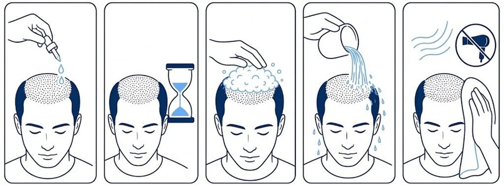 Foam and Rinse Protocol After a Hair Transplant