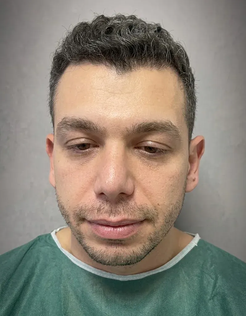 Before beard and mustache transplant at Helia Clinic Dubai — sparse facial hair with surgical design outline.