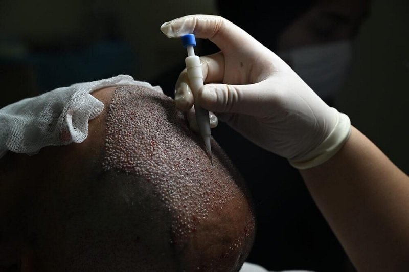 What Is DHI Hair Transplant?