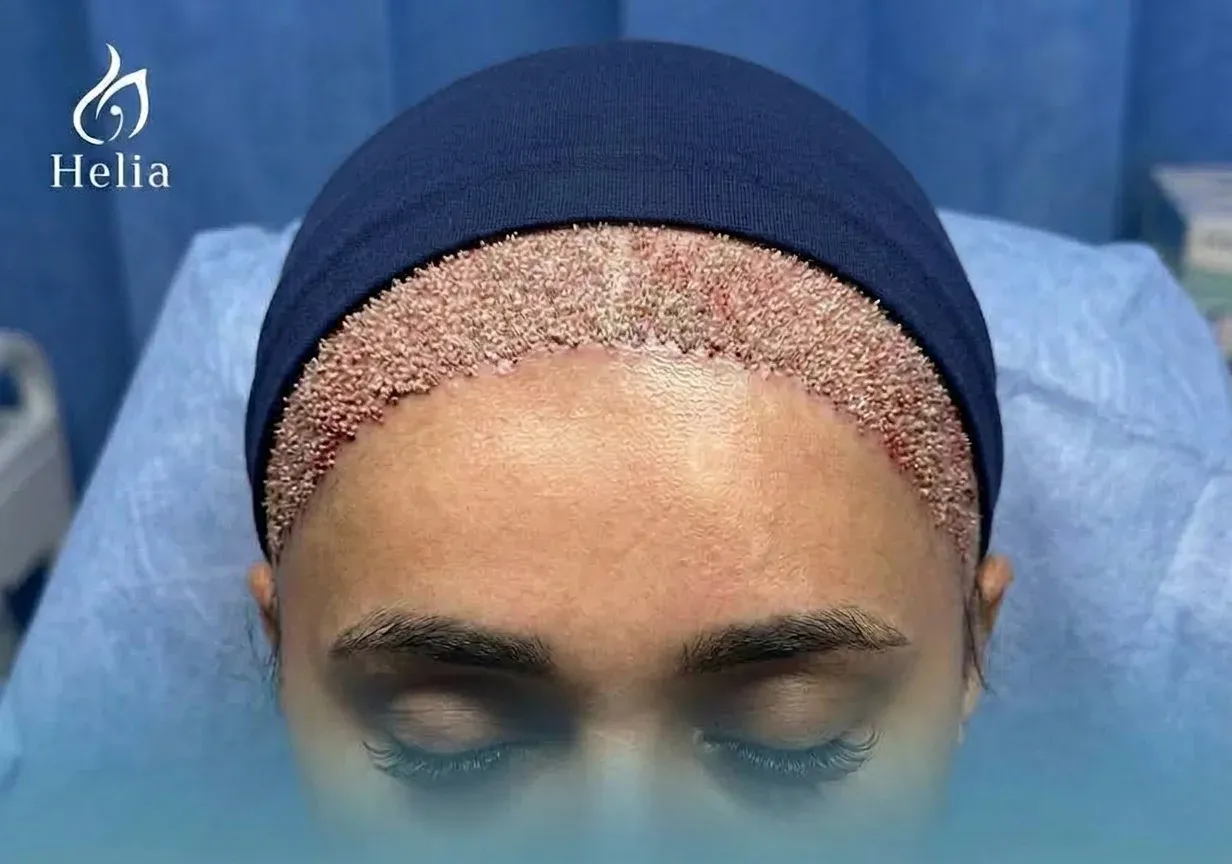 Female hair transplant pre-operative planning at Helia Clinic Dubai, showing a custom-designed hairline and 3000 graft marking on a patient's forehead.